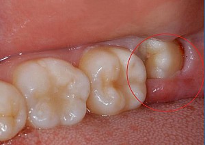 Có nên nhổ răng số 8 khi đang niềng răng?