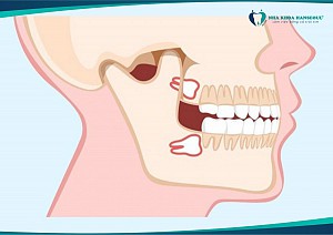 Răng số 8 là gì? Vị trí mọc, cấu tạo và những điều bạn nên biết