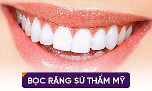 Những trường hợp không nên bọc răng sứ mà bạn cần biết