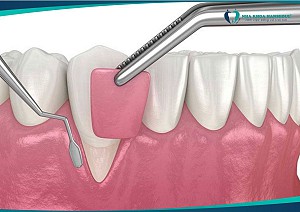 Ghép nướu khi trồng implant là gì? Có cần thiết không?