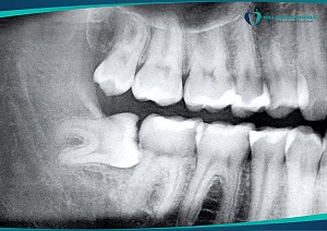 Những biến chứng thường gặp sau khi nhổ răng số 8 và cách xử lý