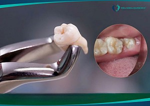 Răng số 8 không đau có nên nhổ không? Chuyên gia nói gì?