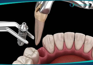 Có nên trồng răng Implant ngay sau khi nhổ răng?