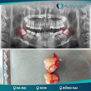 Có nên nhổ răng số 8 khi đang niềng răng?