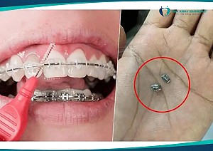 Niềng răng bị bung mắc cài phải làm sao? Hướng xử lý