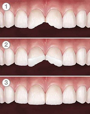Độ tuổi nào niềng răng là tốt nhất? Có nên niềng răng sớm không?