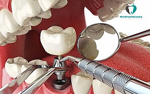 Trồng răng implant có bị hôi miệng không? Cách xử lý hiệu quả