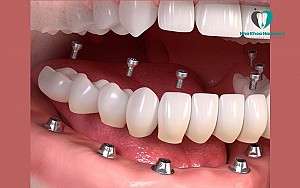 Trồng răng implant có bị hôi miệng không? Cách xử lý hiệu quả