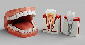 Trồng răng implant có bị hôi miệng không? Cách xử lý hiệu quả