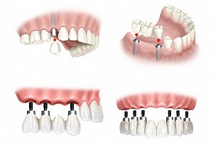 Trồng răng implant có bị hôi miệng không? Cách xử lý hiệu quả