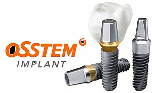 Trồng răng implant có bị hôi miệng không? Cách xử lý hiệu quả