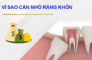 Có nên nhổ răng số 8 khi đang niềng răng?