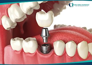Trồng răng implant có bị hôi miệng không? Cách xử lý hiệu quả