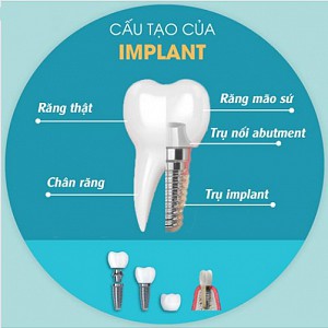 Trồng răng implant có bị hôi miệng không? Cách xử lý hiệu quả