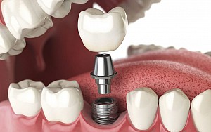 Trồng răng implant có bị hôi miệng không? Cách xử lý hiệu quả