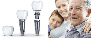 Trồng răng implant có bị hôi miệng không? Cách xử lý hiệu quả