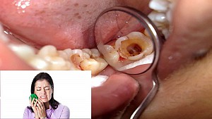 5 bước trong quy trình điều trị tủy răng? Quy trình điều trị diễn ra trong bao lâu?