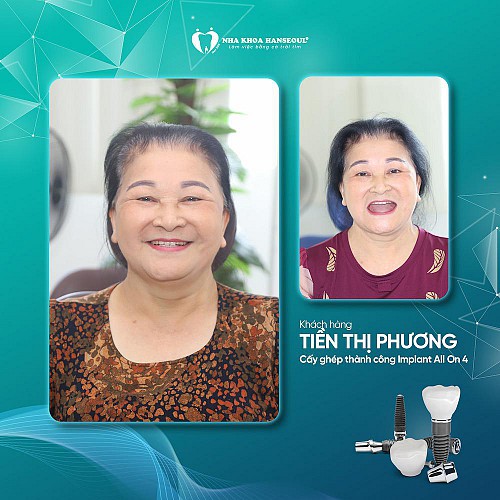 khach-hang-tien-thi-giang-cay-ghep-implant-all-on-4 thumbnail