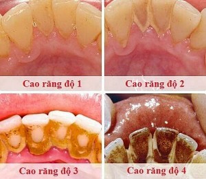 Độ tuổi nào niềng răng là tốt nhất? Có nên niềng răng sớm không?