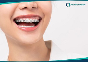 Mắc Cài Niềng Răng: So Sánh Chi Tiết Và Cách Chọn Loại Phù Hợp Nhất