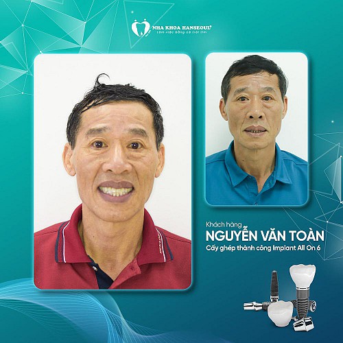 khach-hang-nguyen-van-toan-cay-ghep-implant-all-on-6 thumbnail