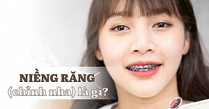Niềng răng bị bung mắc cài phải làm sao? Hướng xử lý