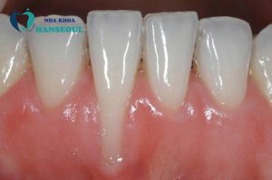 Niềng răng bị tụt lợi – Nguyên nhân và hướng xử lý