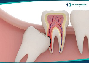 Mọc Răng Số 8 Có Đau Không? Dấu Hiệu Nhận Biết Và Giải Pháp Hiệu Quả