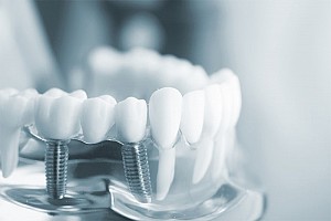 Trồng răng implant có bị hôi miệng không? Cách xử lý hiệu quả