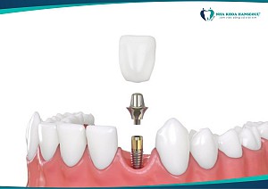 Ưu Điểm Vượt Trội Của Trồng Răng Implant So Với Cầu Răng Và Hàm Giả
