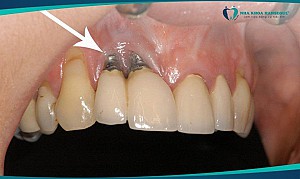 Trồng răng implant có bị hôi miệng không? Cách xử lý hiệu quả