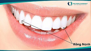 Răng nanh là gì? Tự làm răng nanh tại nhà có được không?