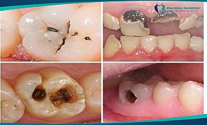 Con sâu răng có thật không? Hình ảnh con sâu răng như thế nào?