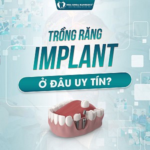 Địa chỉ trồng răng implant uy tín- 4 yếu tố đảm bảo cấy ghép implant thành công