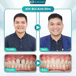 Khách hàng Bùi Anh Dim lấy lại sự tự tin sau khi bọc sứ
