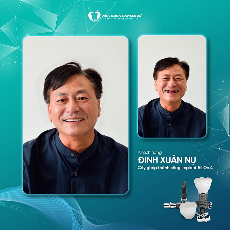 Khách hàng Đinh Xuân Nụ cấy implant All on 4 Khách hàng Đinh Xuân Nụ cấy implant All on 4