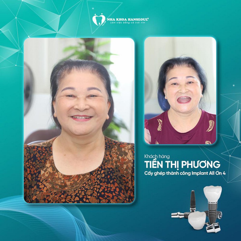 Khách hàng Tiền Thị Giang cấy ghép implant All on 4 Khách hàng Tiền Thị Giang cấy ghép implant All on 4