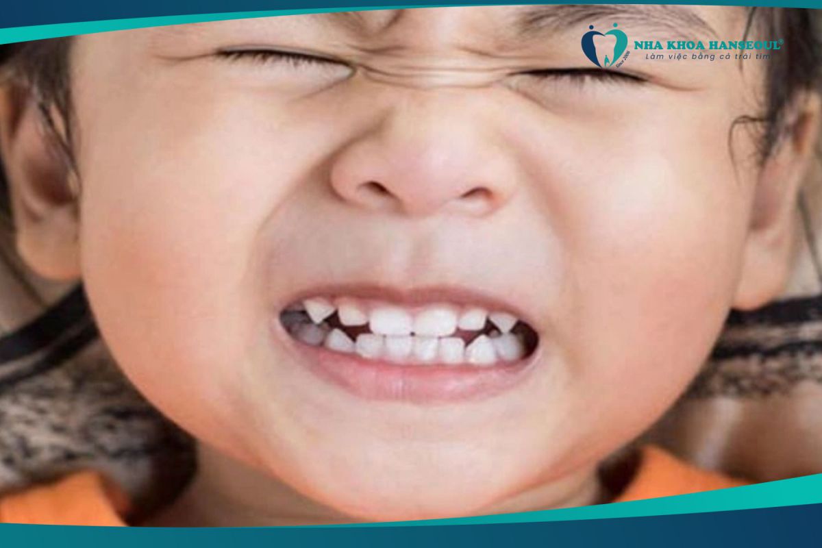 trẻ nghiến răng do lo lắng