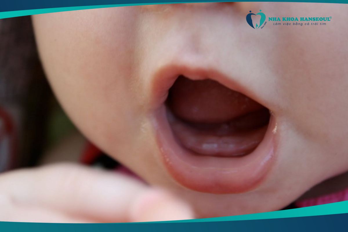 Trẻ nghiến răng do mọc răng