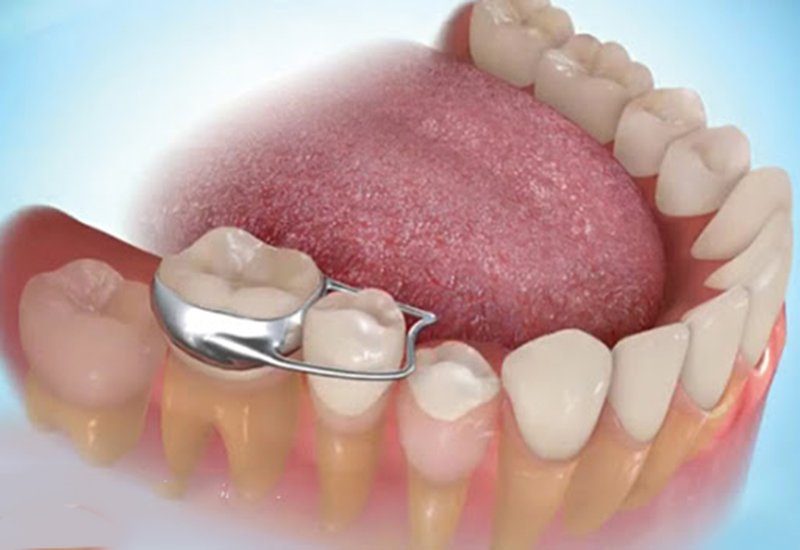 Band chỉnh nha Band chỉnh nha