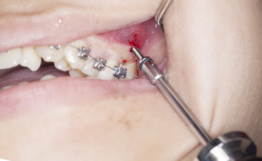 Bắt vít niềng răng Bắt vít niềng răng