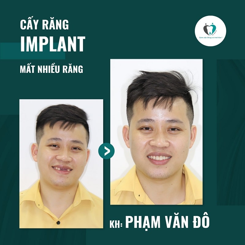 Trước và sau khi trồng răng Implant tại nha khoa Hanseoul Trước và sau khi trồng răng Implant tại nha khoa Hanseoul