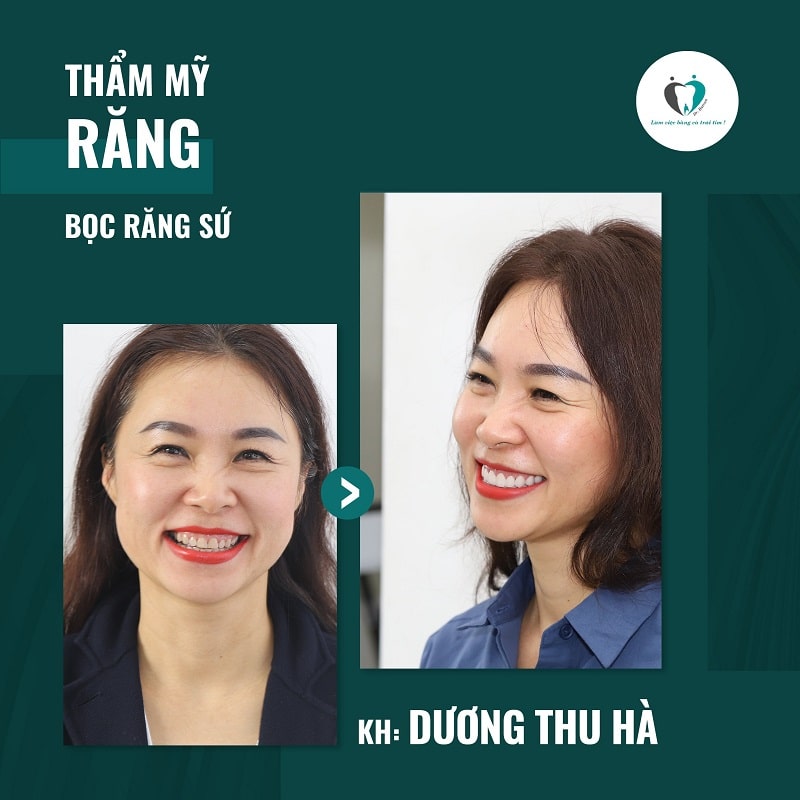 Bệnh nhân bọc răng sứ