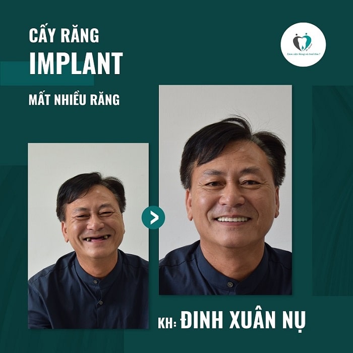 Bệnh nhân sau khi trồng răng implant