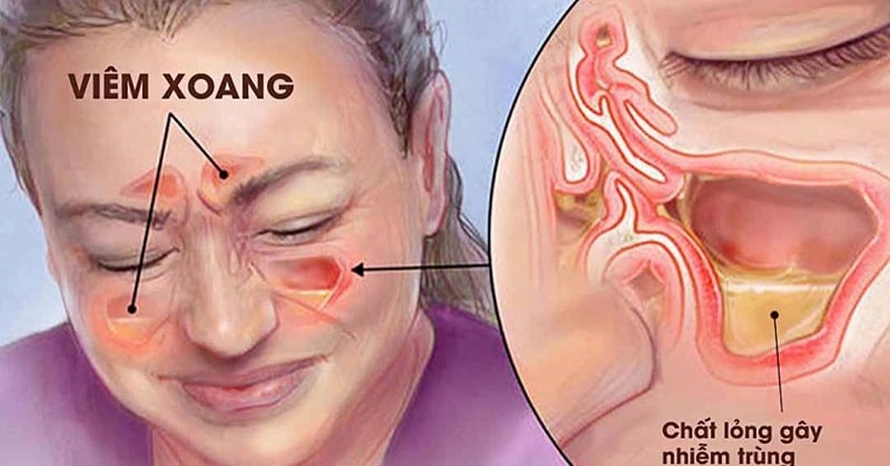 Bệnh viêm xoang