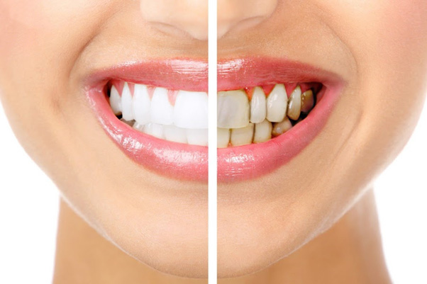 Bọc răng sứ toàn hàm