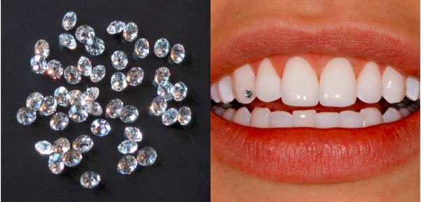 Các loại đính đá lên răng Các loại đính đá lên răng