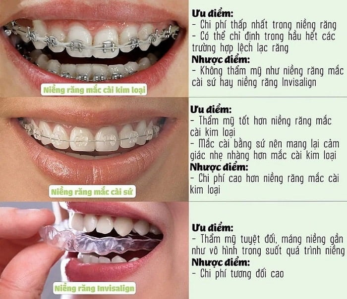 Các loại mắc cài niềng răng Các loại mắc cài niềng răng