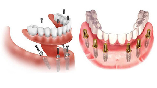 Kỹ thuật cấy ghép Implant All On 6