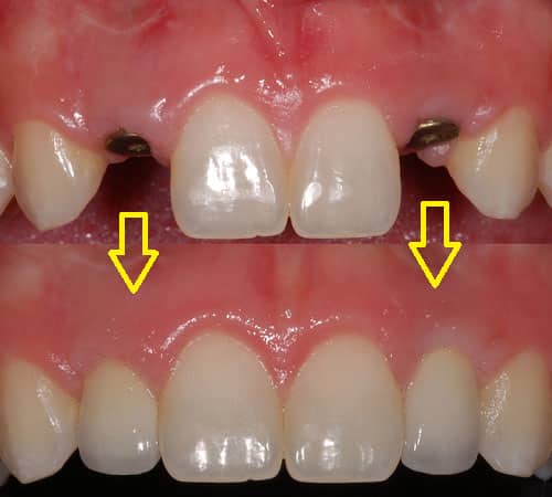 Cấy ghép implant sau khi nhổ răng 3 tháng Cấy ghép implant sau khi nhổ răng 3 tháng